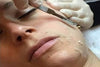 Dermaplaning Treatment